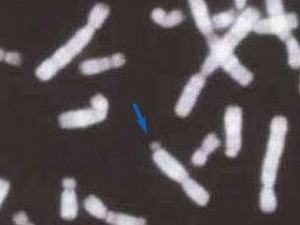 fragilt-x-kromosom